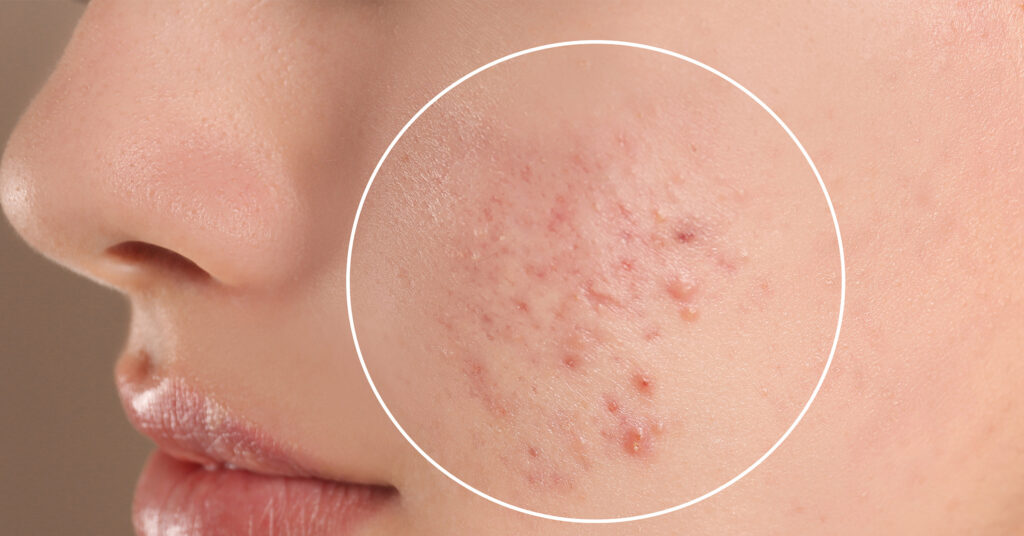 A girl experiencing acne problems