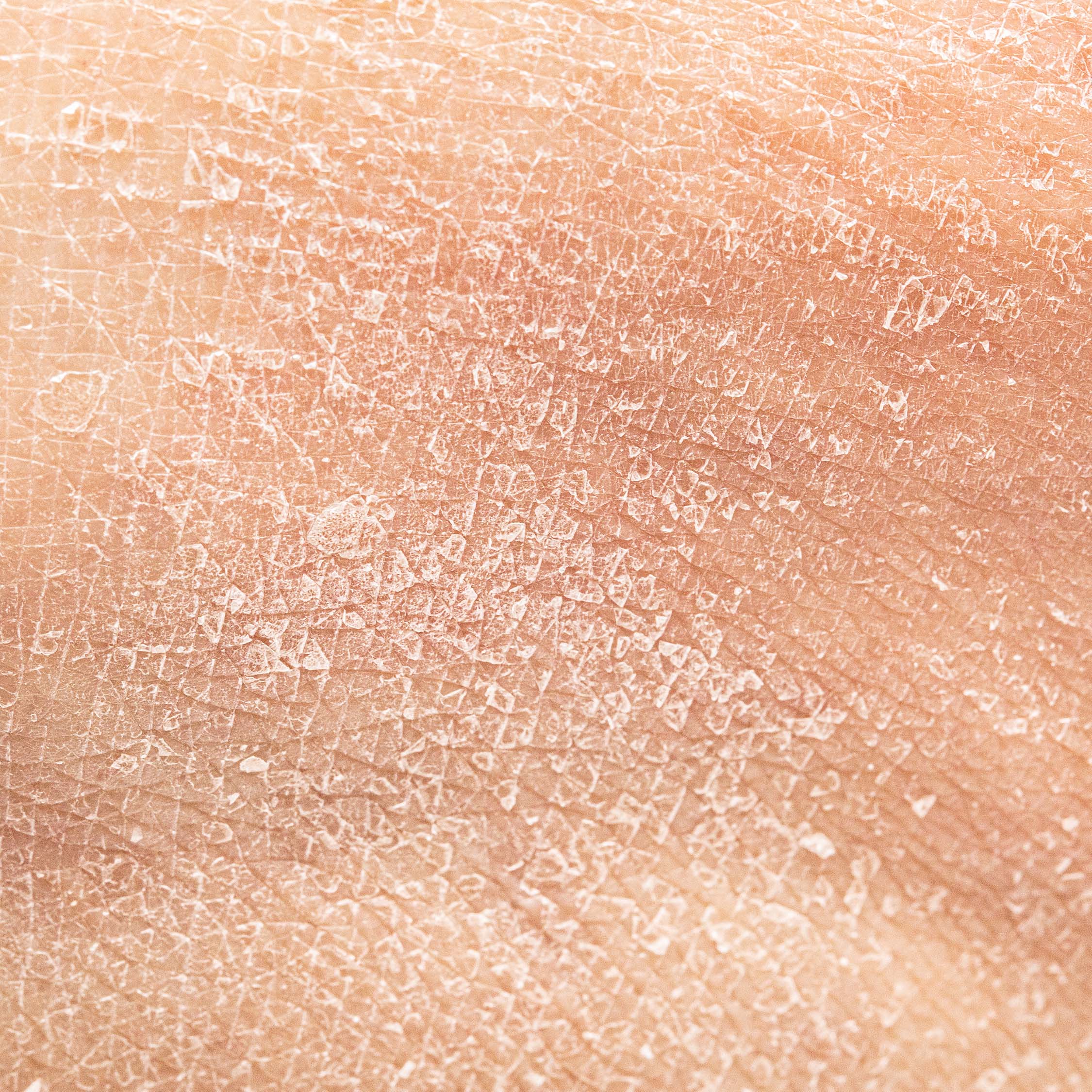 Macro shot of dry skin